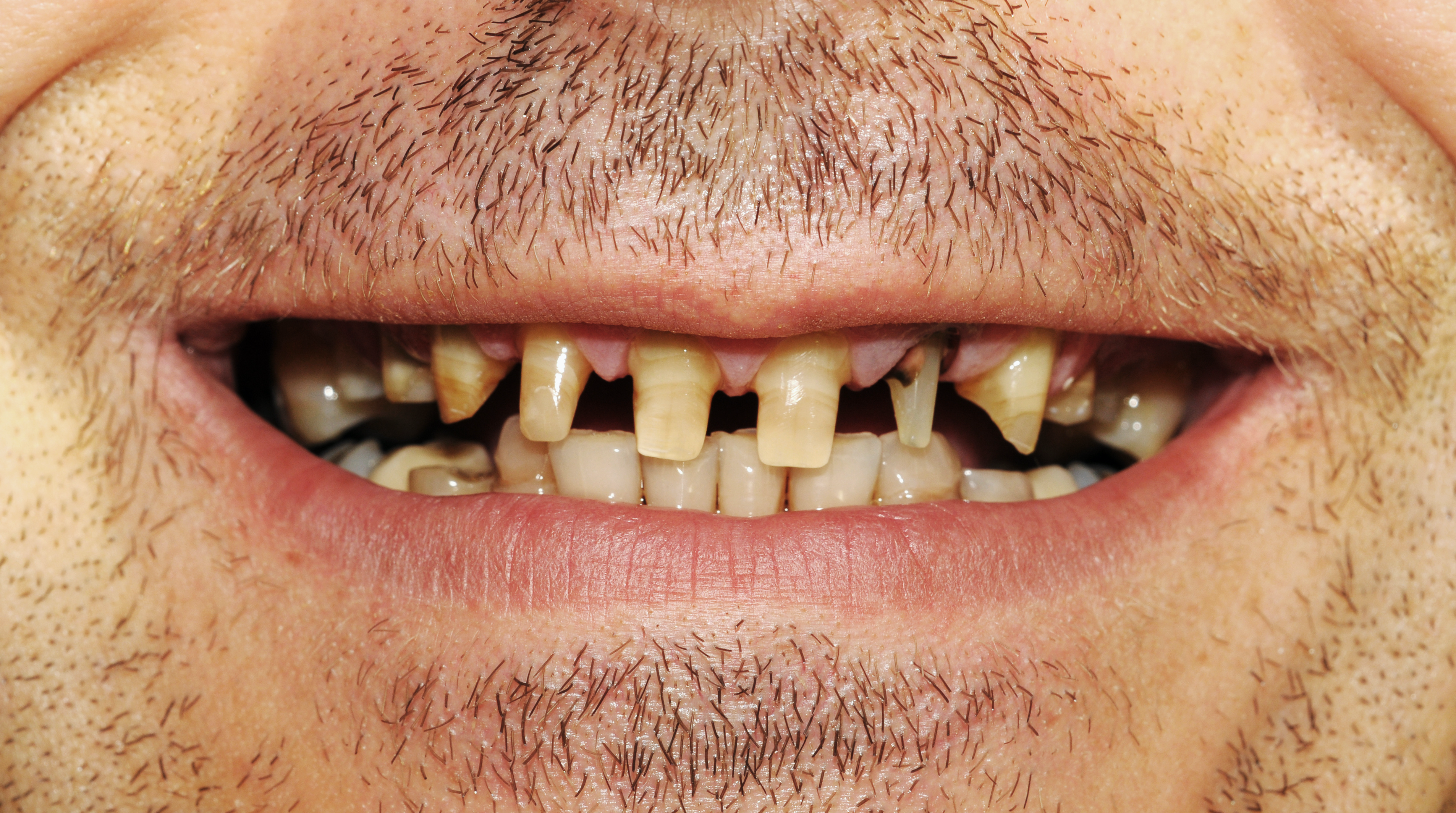 Zahn Implantate 