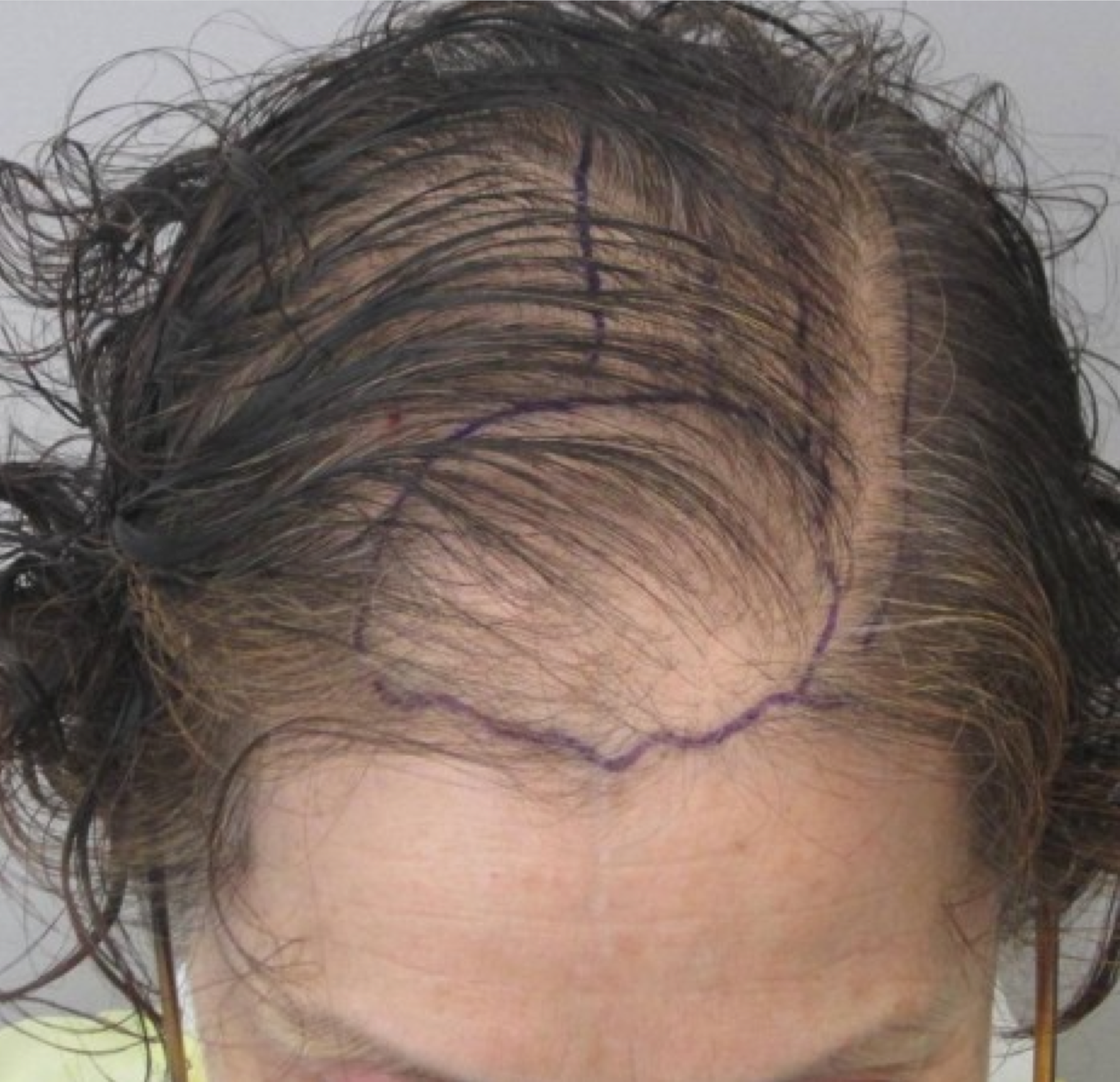 Haartransplantation Frau 1
