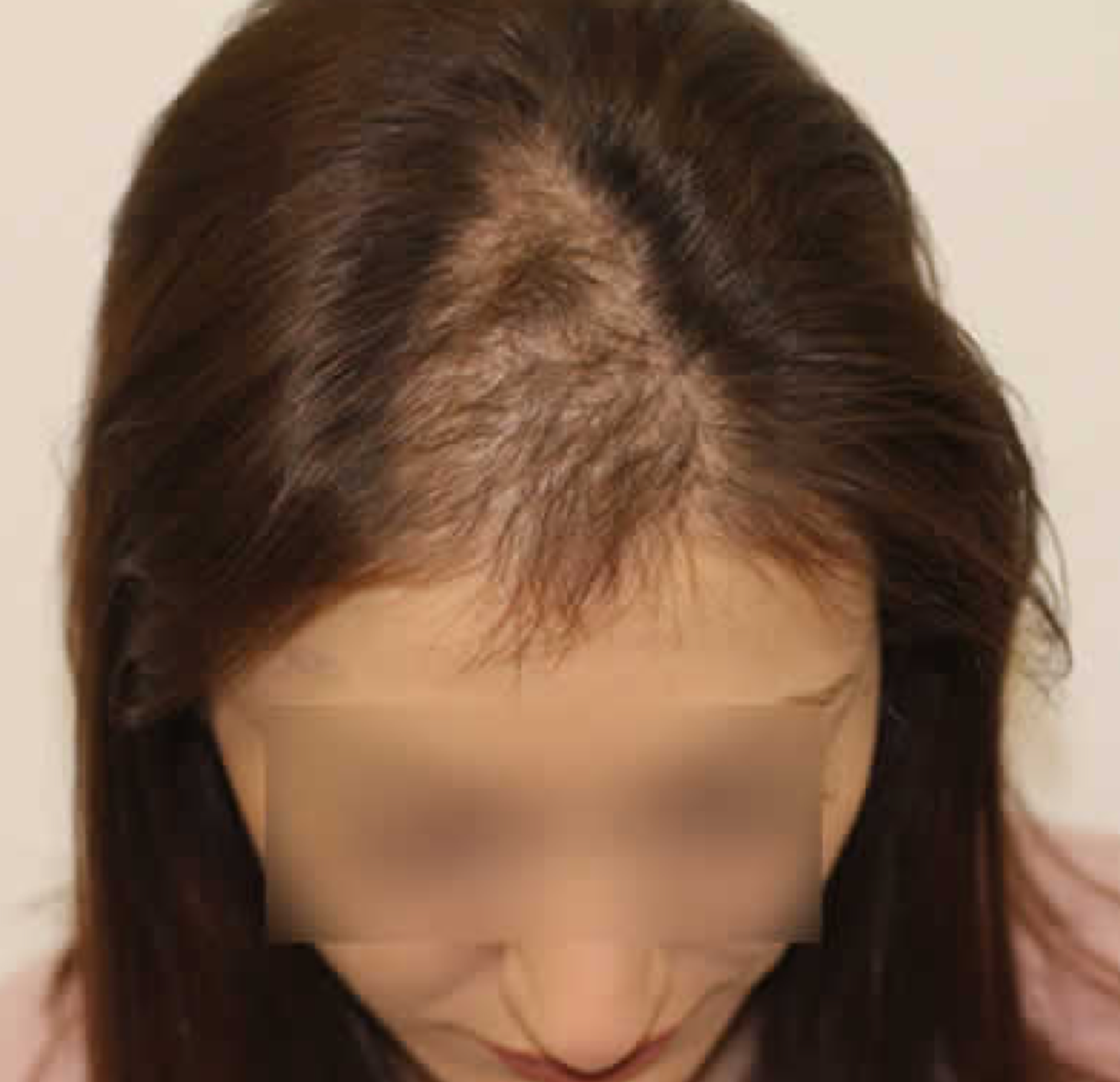 Haartransplantation Frau 2